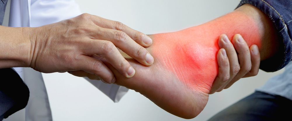 What is Gout? What is Good for Gout?